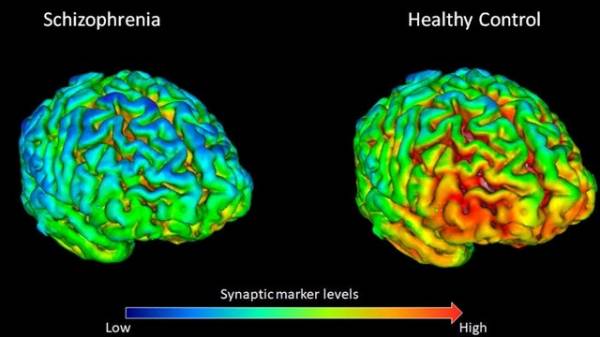 Tìm thấy sự khác biệt trong bộ não của những người bị tâm thần phân liệt
