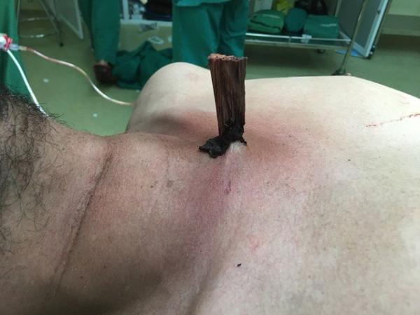 Bác sĩ xoa bóp tim cứu nạn nhân bị gỗ đâm xuyên động mạch