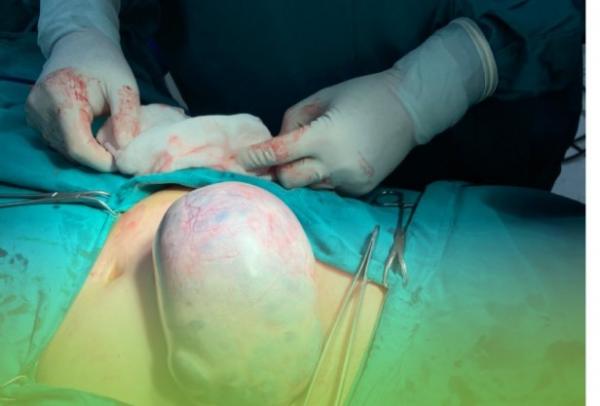 Báo động trẻ hoá bệnh nhân u nang buồng trứng