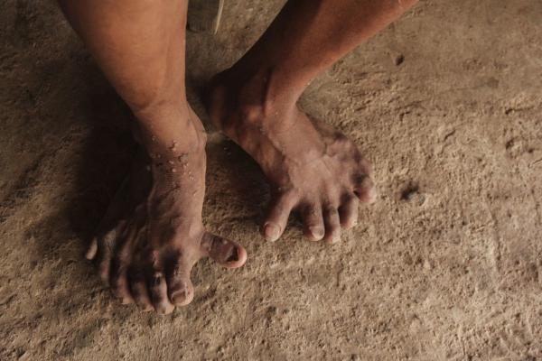 Kỳ lạ 2 anh em có 26 ngón tay, chân ở Quảng Bình