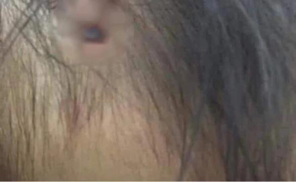 Sự thật bức ảnh được cho là của bé gái 3 tuổi ở Hà Nội với chiếc đinh găm thẳng vào đầu gây xôn xao MXH