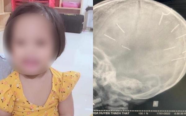 Cập nhật sức khoẻ bé gái 3 tuổi ở Hà Nội bị nhân tình của mẹ đóng đinh vào đầu: Đã được tháo bột ở cánh tay nhưng vẫn hôn mê