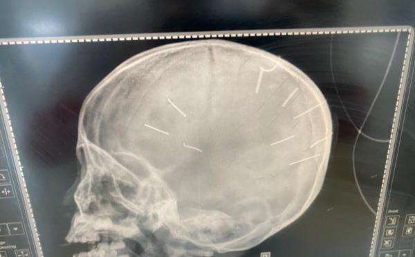Bác sĩ chia sẻ tình trạng những ngày cuối đời của bé gái 3 tuổi bị đóng đinh vào đầu