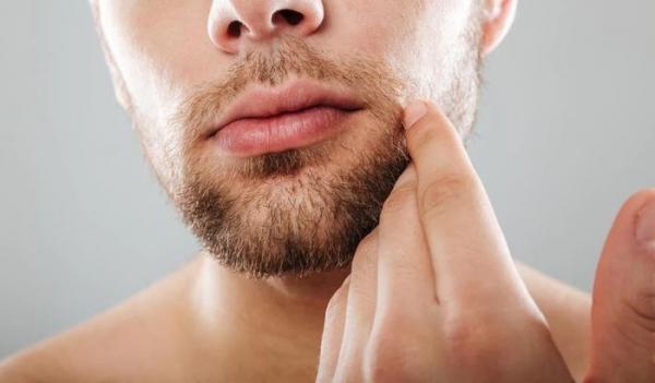 Giải quyết nỗi lo gàu râu cho nam giới