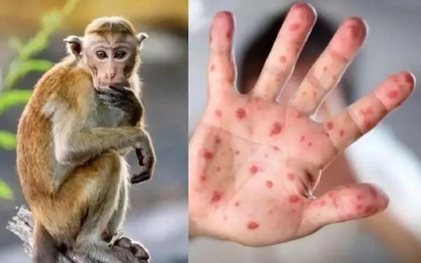 Campuchia ghi nhận thêm ba ca mắc bệnh đậu mùa khỉ