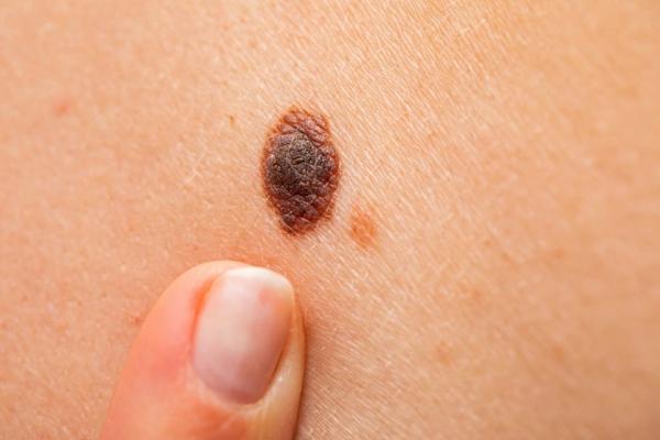 Nốt ruồi bất thường có thể là dấu hiệu ung thư da