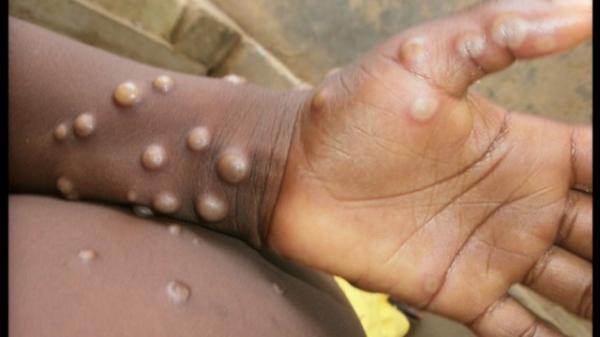 Số ca nhiễm đậu mùa khỉ đang tăng cao trên thế giới: Lây truyền qua đâu, triệu chứng thế nào?