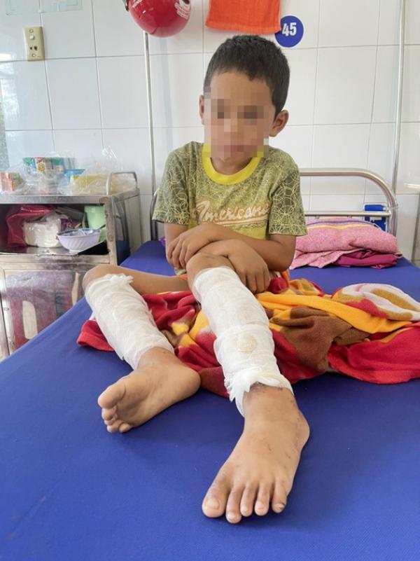 Quảng Bình: Một cháu bé bị cha dùng xăng và rơm đốt