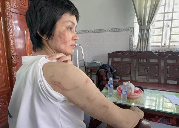 205 vết thương trên người vợ bầu 7 tháng, là tra tấn chứ không phải B.L