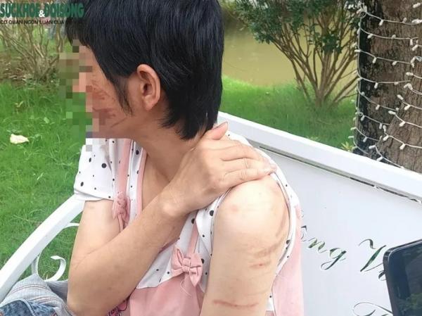 Thông tin mới nhất vụ vợ mang bầu 7 tháng bị chồng B.H dã man ở Hải Dương