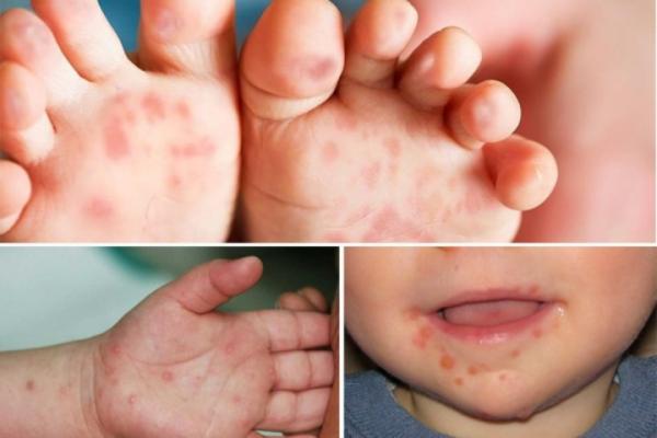TP.HCM: Bé 5 tuổi tử vong nghi mắc tay chân miệng