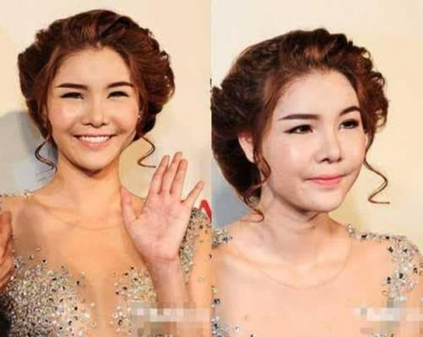 Người mẫu Kỳ Hân - vợ Mạc Hồng Quân - khủng hoảng vì khuôn mặt biến dạng do phẫu thuật thẩm mỹ