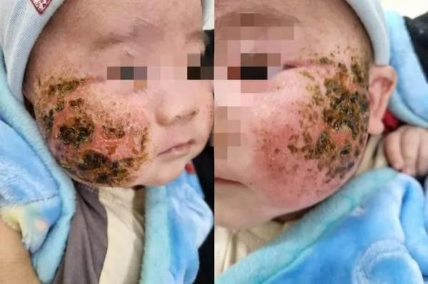 Tự đắp lá cây chữa viêm da, bé trai 4 tháng tuổi bị loét má