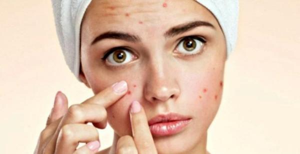 3 tác hại nghiêm trọng của thói quen nặn mụn