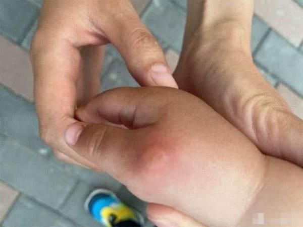 Bị muỗi đốt, bôi nước bọt có tốt không? 7 mẹo giảm ngứa hiệu quả ít người biết