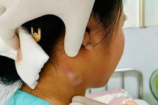 Bé gái 14 tuổi ở Đồng Nai nhiễm “vi khuẩn ăn thịt người”