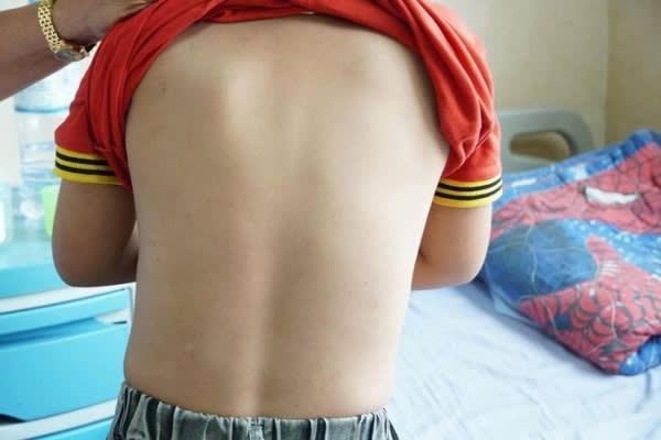 Bé trai nhập viện khẩn cấp do mày đay nhiễm khuẩn