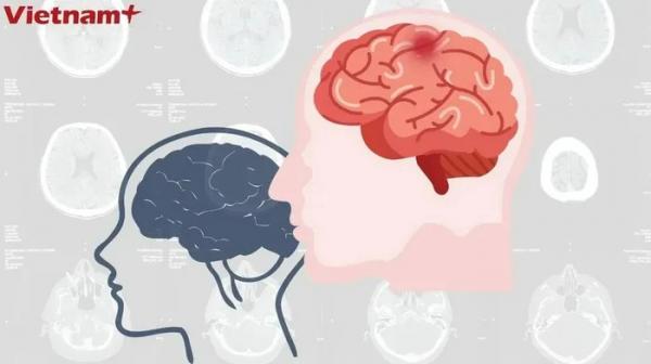 Đột phá mới: Kéo dài thời gian sống cho bệnh nhân mắc u não ác tính