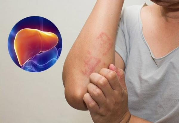 4 dấu hiệu chứng tỏ bệnh gan đã đi vào giai đoạn nặng: 1/4 cũng phải đi khám
