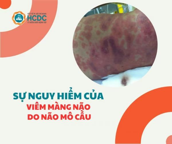 TPHCM cảnh báo căn bệnh nguy hiểm, có thể gây t‌ử von‌g chỉ sau vài giờ