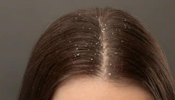 4 mẹo cơ bản giúp bạn nói lời “tạm biệt” với gàu