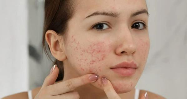 Thâm mụn và lộ trình chăm sóc giúp da phục hồi nhanh hơn